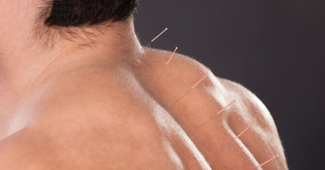 Acupuncture for Men's Health image
